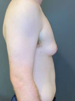 Gynecomastia (male breast reduction)