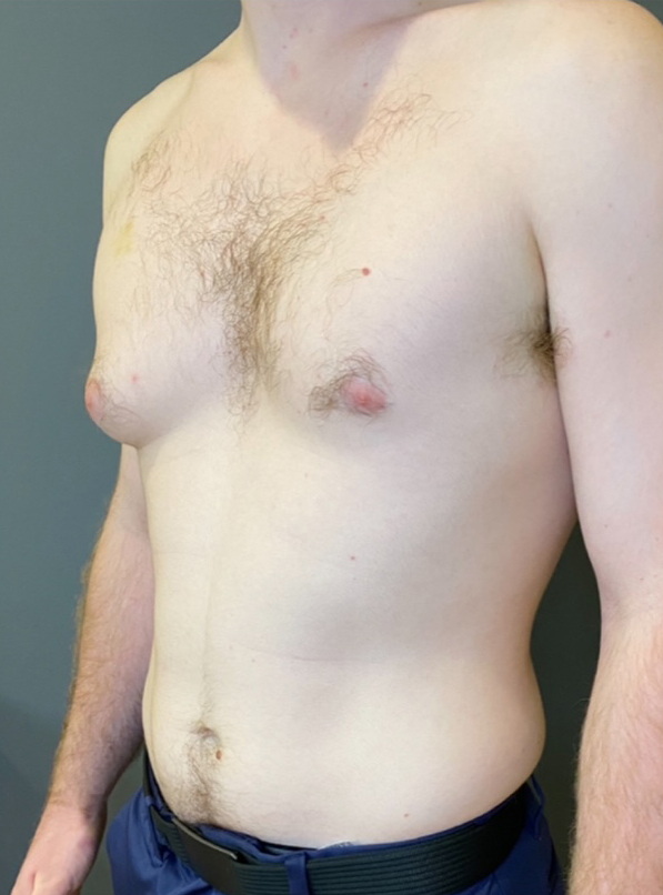 Gynecomastia (male breast reduction)