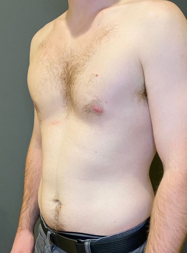 Gynecomastia (male breast reduction)