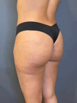 Brazilian Buttocks Lift (BBL)