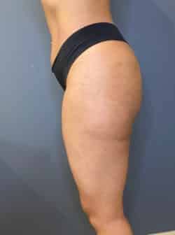 Brazilian Buttocks Lift (BBL)