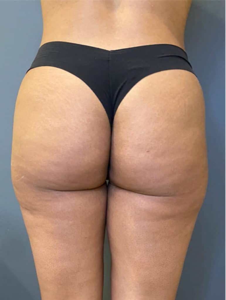 Brazilian Buttocks Lift (BBL)