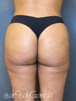 Brazilian Buttocks Lift (BBL)