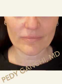 Face / Neck Lift