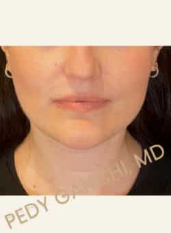 Face / Neck Lift