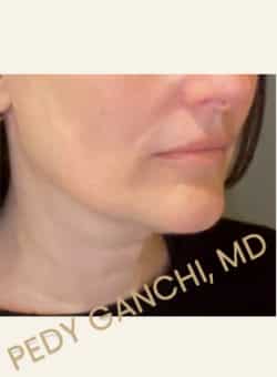 Face / Neck Lift