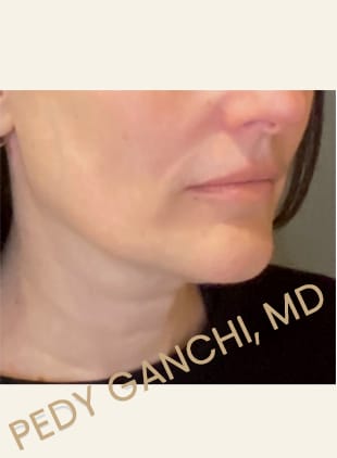 Face / Neck Lift