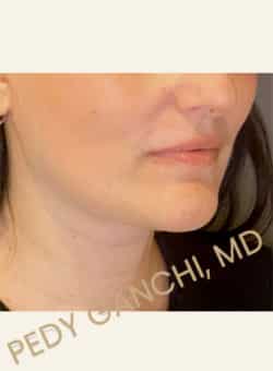 Face / Neck Lift