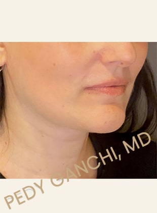 Face / Neck Lift