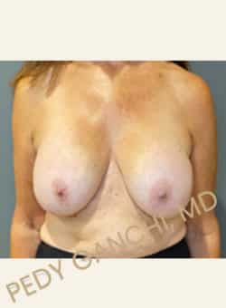 Breast Augment with Lift