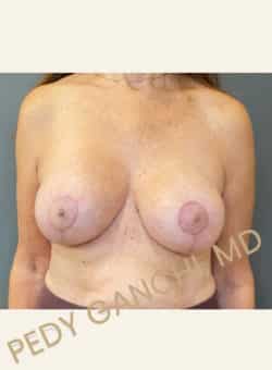 Breast Augment with Lift