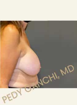 Breast Augment with Lift