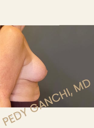 Breast Augment with Lift