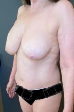 Breast Fat Grafting