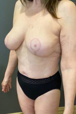 Breast Fat Grafting