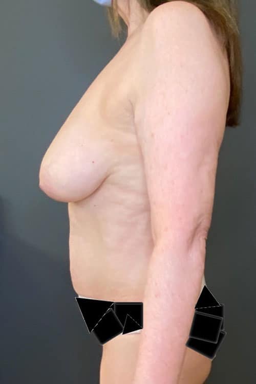 Breast Fat Grafting