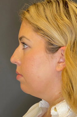 Chin Augmentation - Neck Liposuction