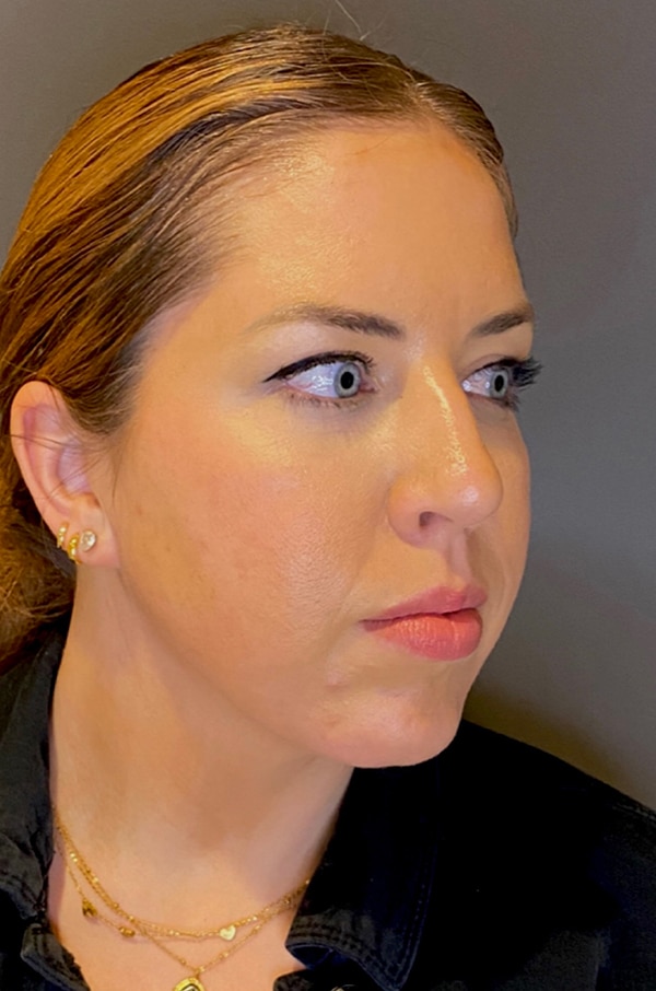 Chin Augmentation - Neck Liposuction