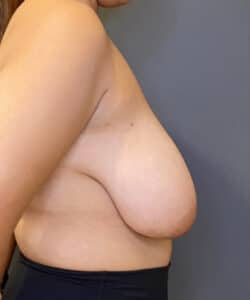 Breast Reduction (female)