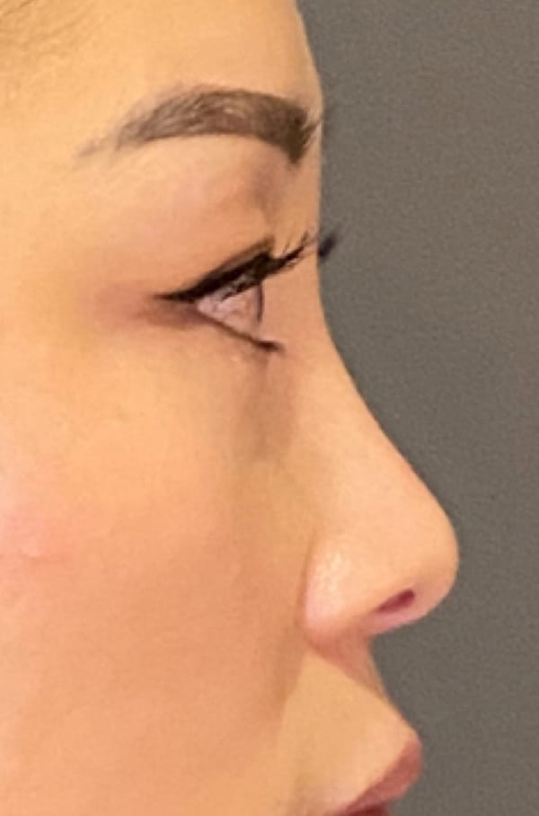 Eyelid Tuck