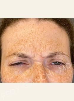 BOTOX-Dysport