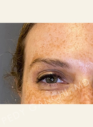 BOTOX-Dysport