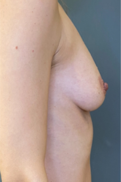 Breast Fat Grafting