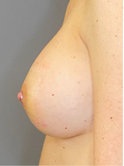Nipple and Areola Surgery