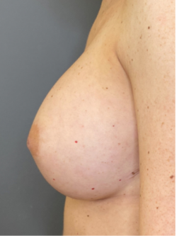 Nipple and Areola Surgery