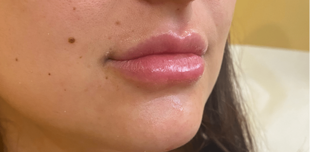 Lip Augmentation