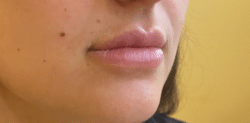 Lip Augmentation