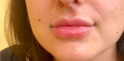 Lip Augmentation