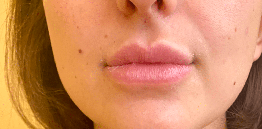 Lip Augmentation