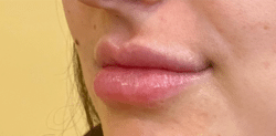 Lip Augmentation