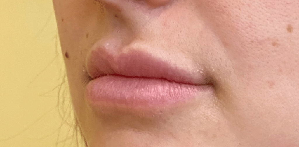 Lip Augmentation