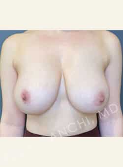 Breast Reduction (female)