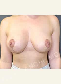 Breast Reduction (female)