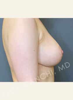 Breast Reduction (female)