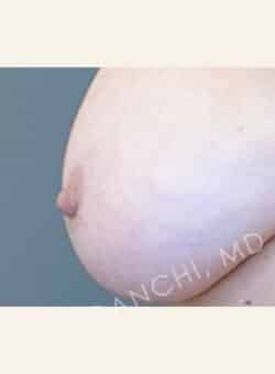 Nipple and Areola Surgery