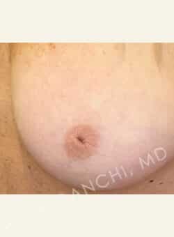 Nipple and Areola Surgery