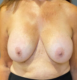 Breast Implant Revision (Explant)