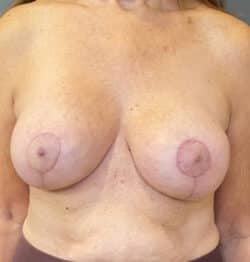 Breast Implant Revision (Explant)