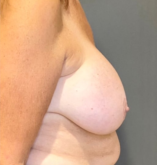 Breast Implant Revision (Explant)