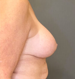 Breast Implant Revision (Explant)