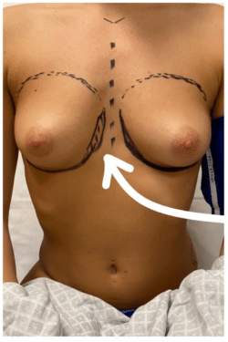 Breast Augmentation (Implants)