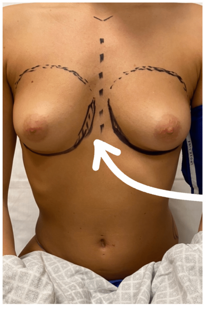 Breast Augmentation (Implants)