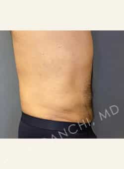 Tummy Tuck