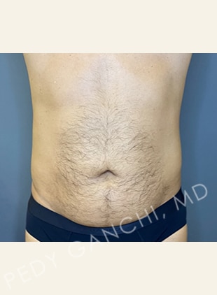 Tummy Tuck