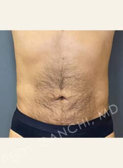 Tummy Tuck