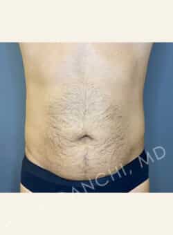 Tummy Tuck